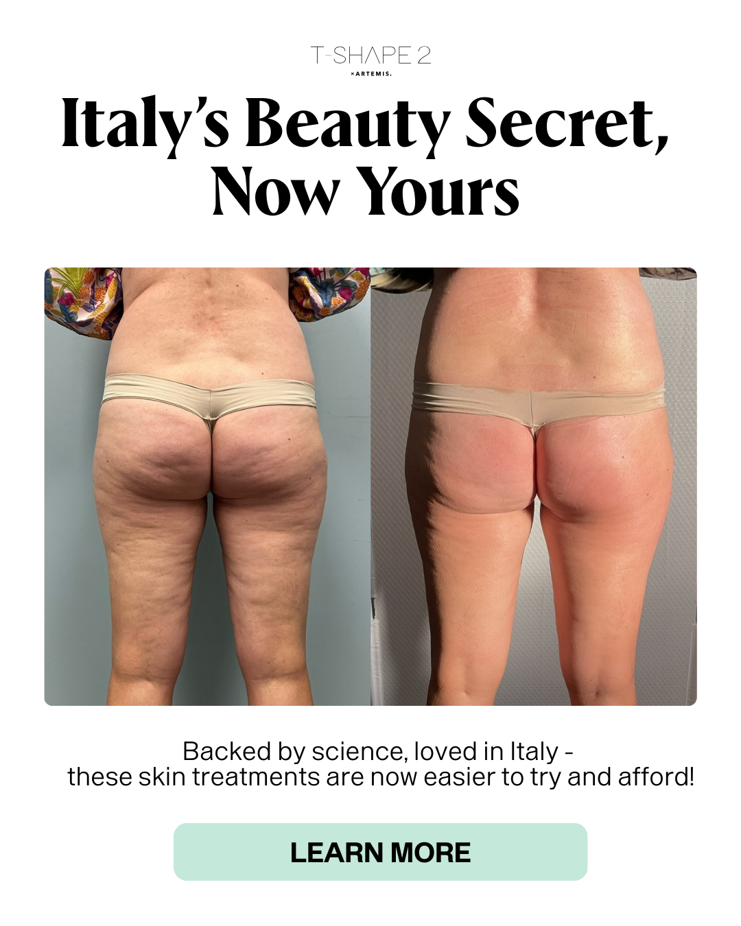 Buttock firming before and after